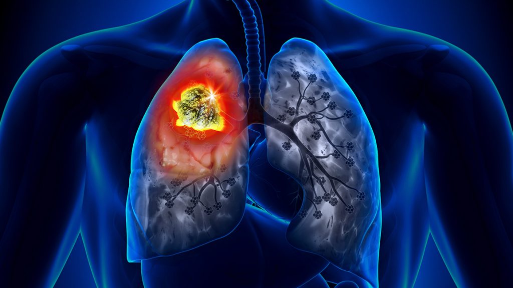 Doctors Stunned: Vitamin B3 Shows Breakthrough Results for COPD